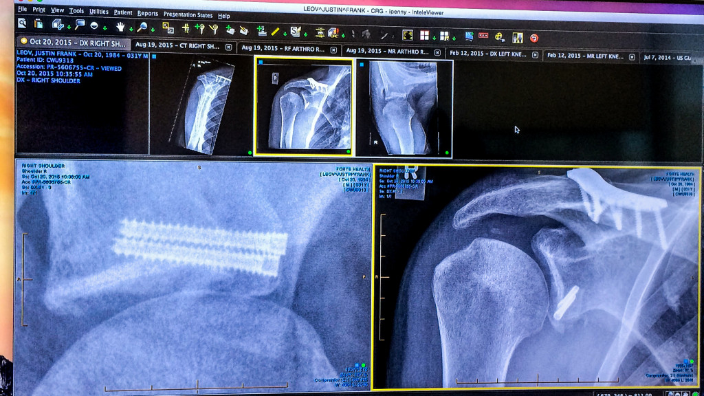 click to enlarge Radiografia della spalla destra (photo by Justin Leov)