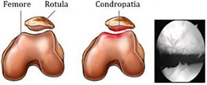 condropatia